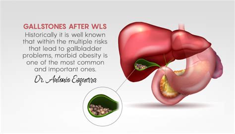 a gallstones after gastric bypass